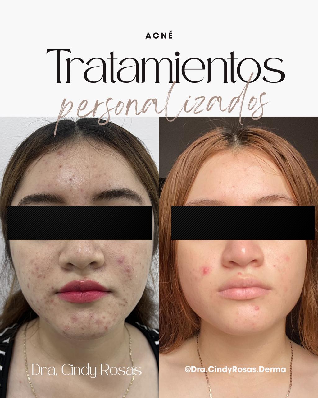 Procedimiento dermatológico